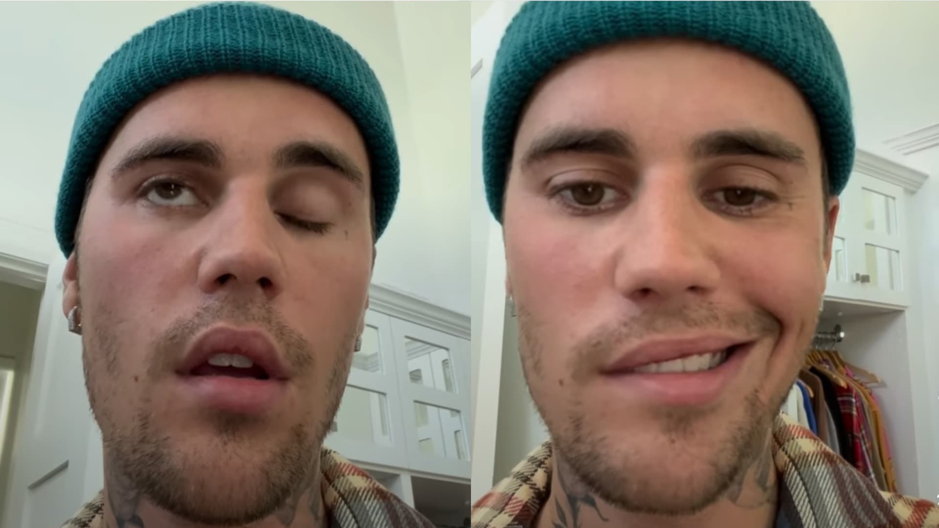 Kanadskej hviezde ochrnula polovica tváre! Justin Bieber trpí vážnym ochorením