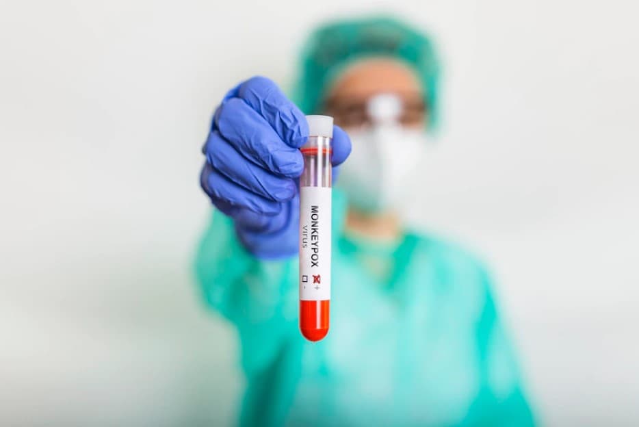 Na Slovensku pribudli v tomto týždni ďalšie prípady opičích kiahní